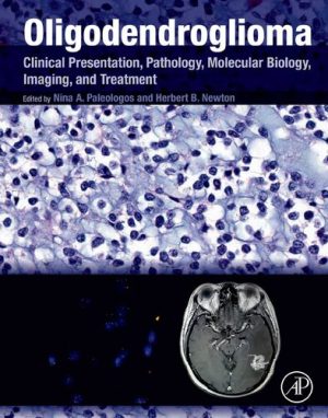Oligodendroglioma Clinical Presentation Pathology Molecular Biology Imaging and Treatment