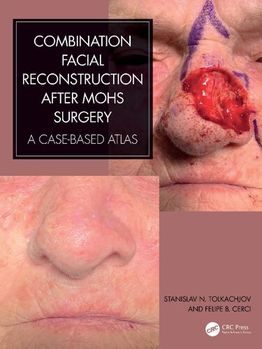 Combination Facial Reconstruction after Mohs Surgery A Case Based Atlas