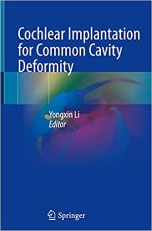 Cochlear Implantation for Common Cavity Deformity