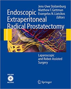 Endoscopic Extraperitoneal Radical Prostatectomy Laparoscopic and Robot Assisted Surgery
