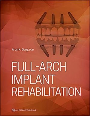 Full Arch Implant Rehabilitation
